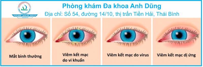 BỆNH VIÊM KẾT MẠC MẮT: NGUYÊN NHÂN, TRIỆU CHỨNG, CÁCH ĐIỀU TRỊ VÀ PHÒNG TRÁNH